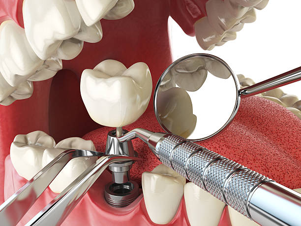 Best Emergency Dental Extractions in Villa Park, CA