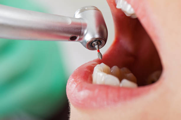 Best Emergency Dentist for Lost Fillings or Crowns in Villa Park, CA